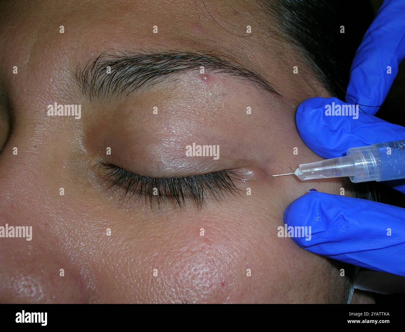 Hidrocystoma Excision Local Anaesthetic Being Injected Prior To The hidrocystoma-excision-local-anaesthetic-being-injected-prior-to-the