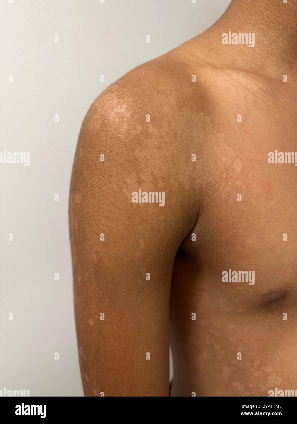 Lesions (light areas) on the shoulder of a 15 year old Malaysian ...