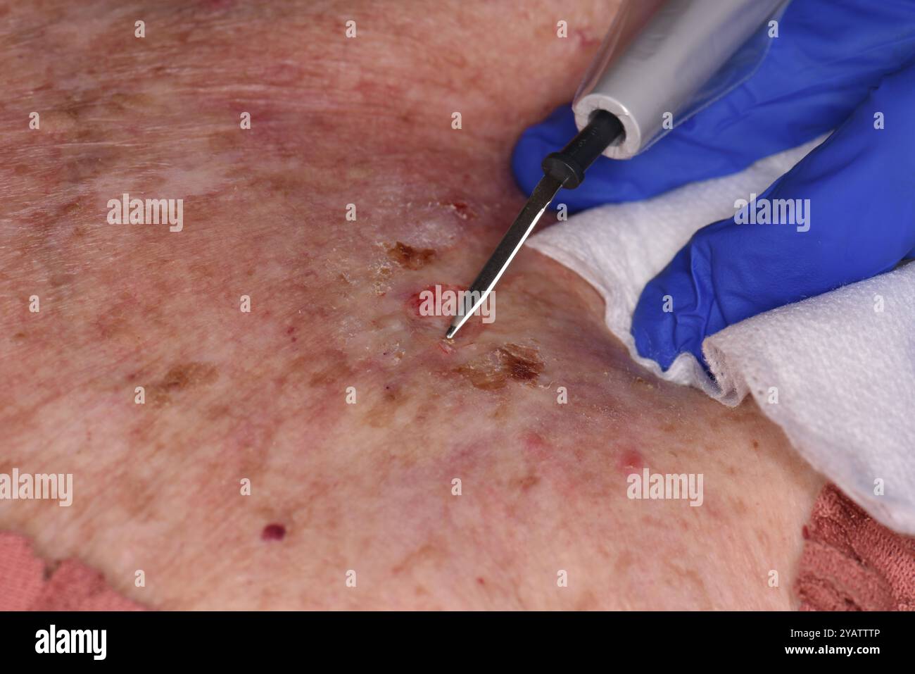 Lesion On The Chest Of A 72 Year Old White Female Patient With Bowen S