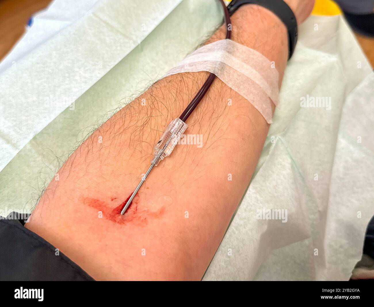 Close up view of a needle in the arm of a blood donor. - Smartphone Captured Stock Image