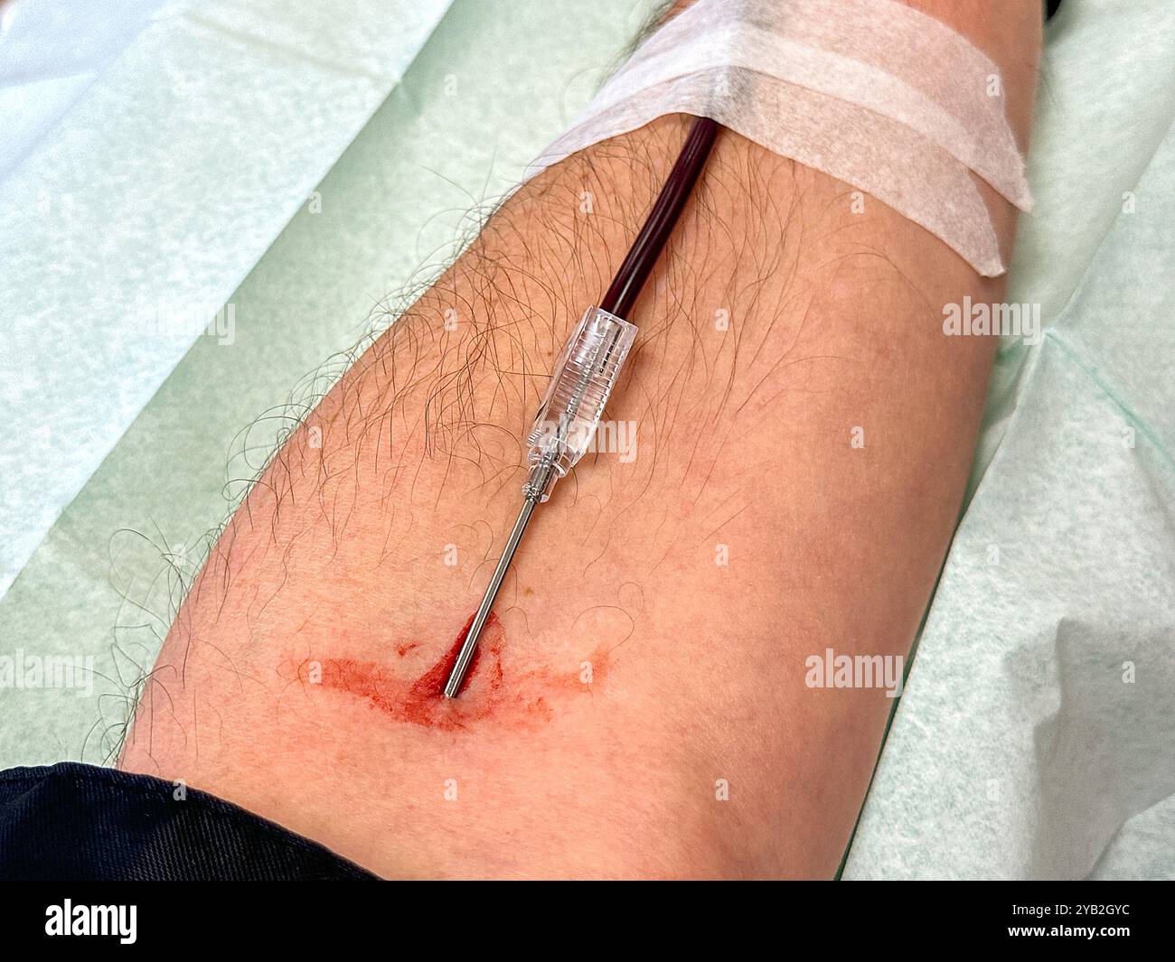 Close up view of a needle in the arm of a blood donor. - Smartphone Captured Stock Image