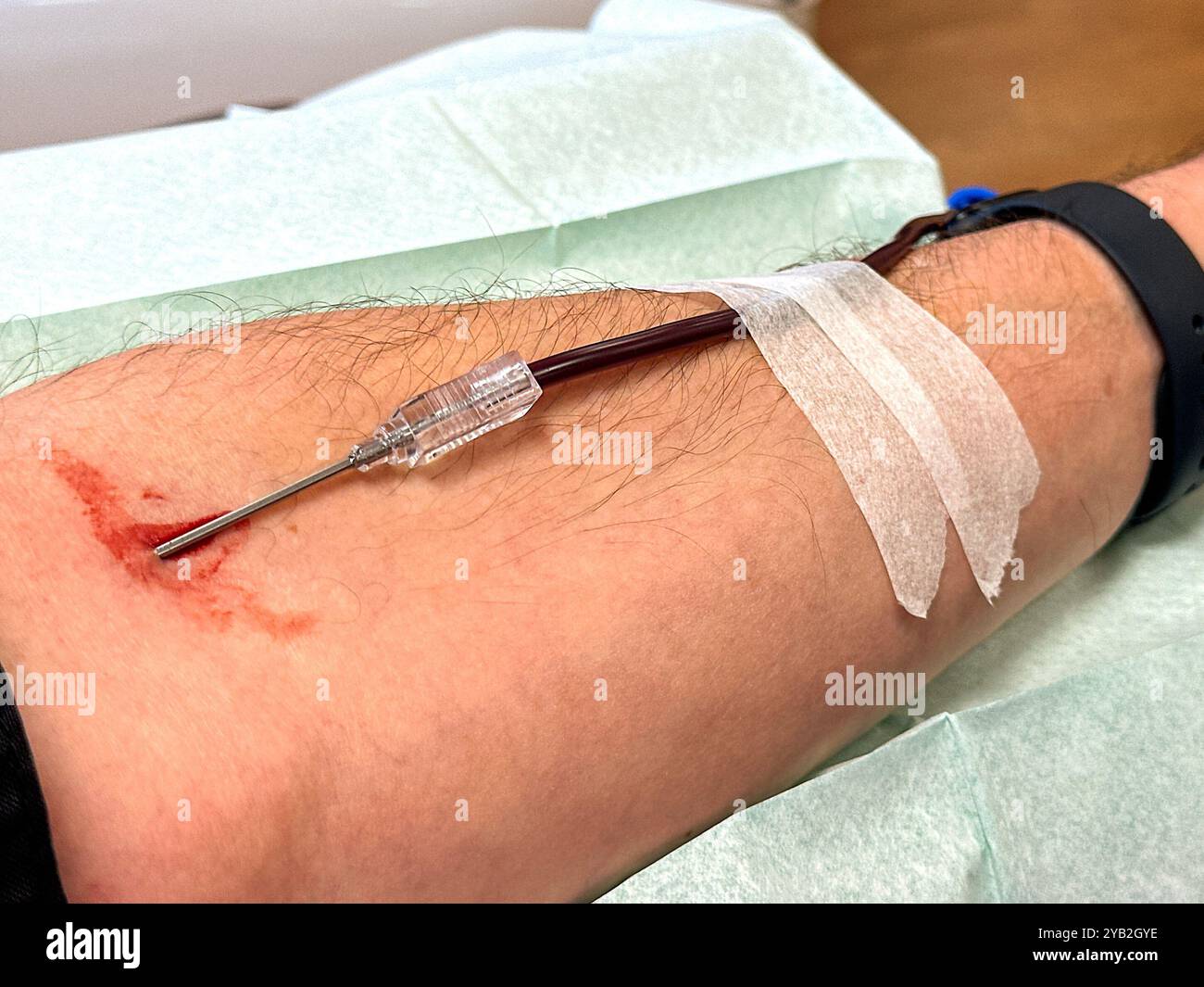 Close up view of a needle in the arm of a blood donor. - Smartphone Captured Stock Image