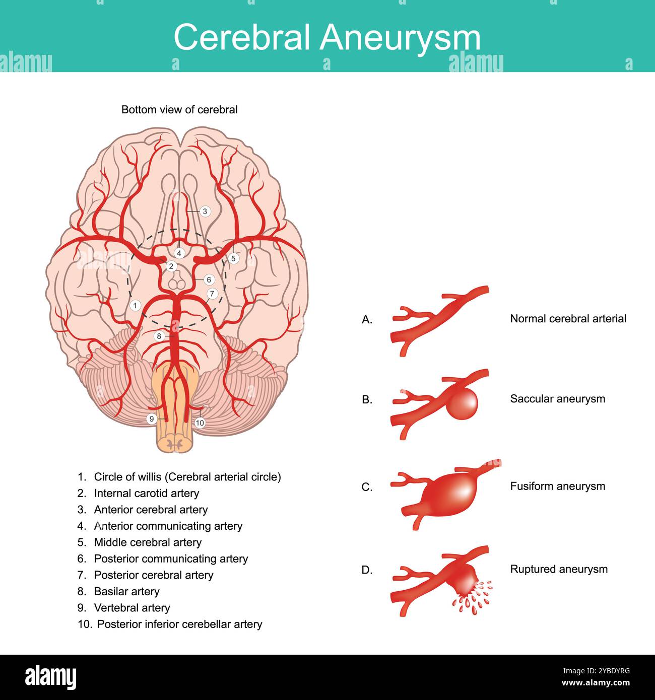 Cerebral Aneurysm. A bulging artery weakened area in the wall of an artery in the brain. Stock Photo