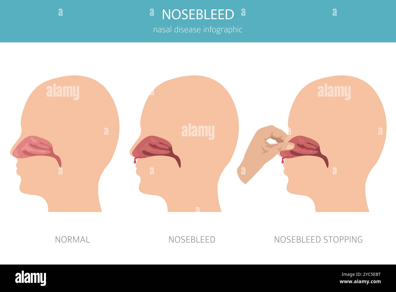 Nosebleed. Nasal diseases. Medical infographic design. Vector illustration Stock Vector