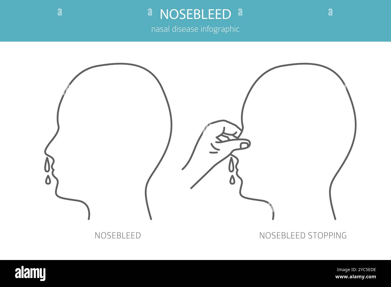 Nosebleed. Nasal diseases. Medical infographic design. Vector illustration Stock Vector