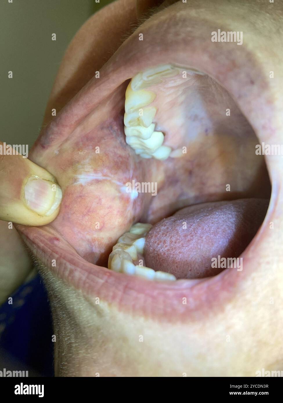 Oral lichen planus in a 50 year old female Persian patient. Lichen ...