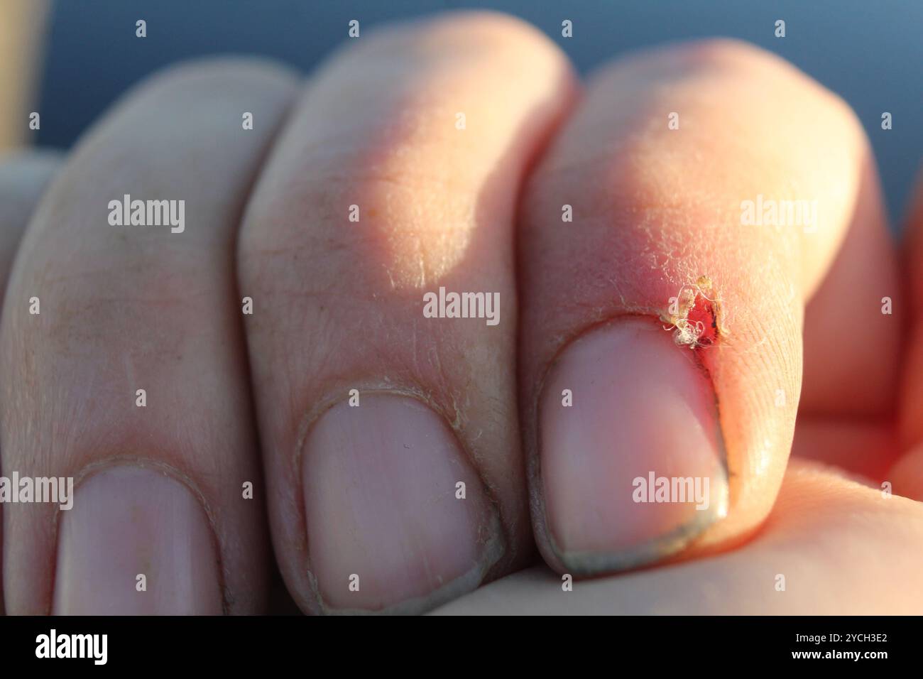 Injury on the finger. Skin injuries on the finger. Wound and mutilation of hands. Stock Photo
