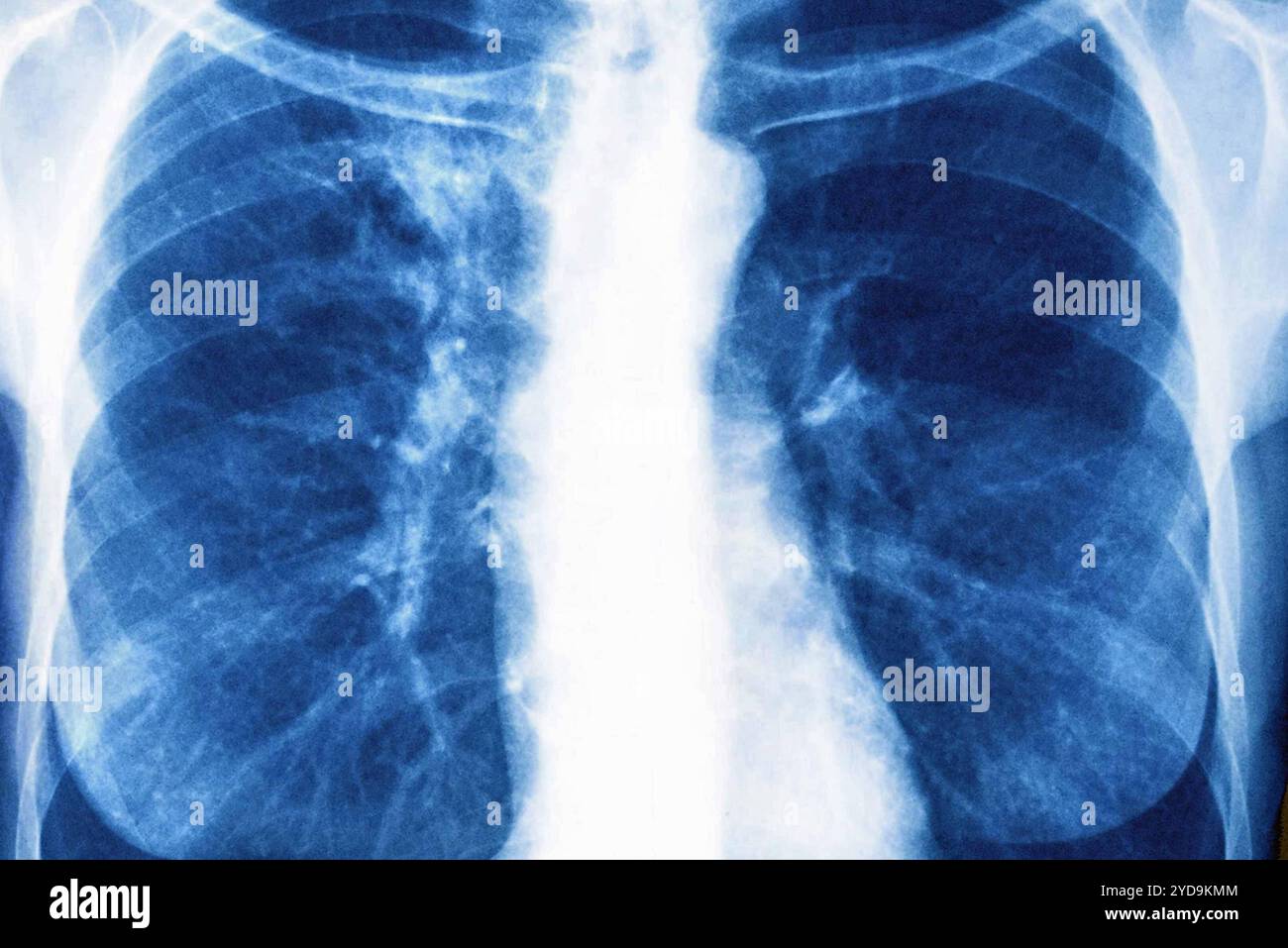 Right and left lung cancer stage 1. Front chest x-ray. Lung cancer 016836 025 Stock Photo