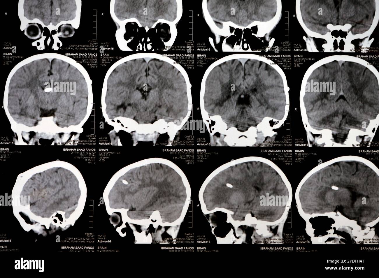 Cairo, Egypt, September 17 2024: Brain CT scan reveals left shunt tube terminating in right lateral ventricle, with no residual ventricular dilatation Stock Photo