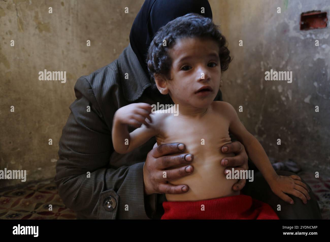 Qamar al-Ghorani is a one and a half year-old child affected by severe ...