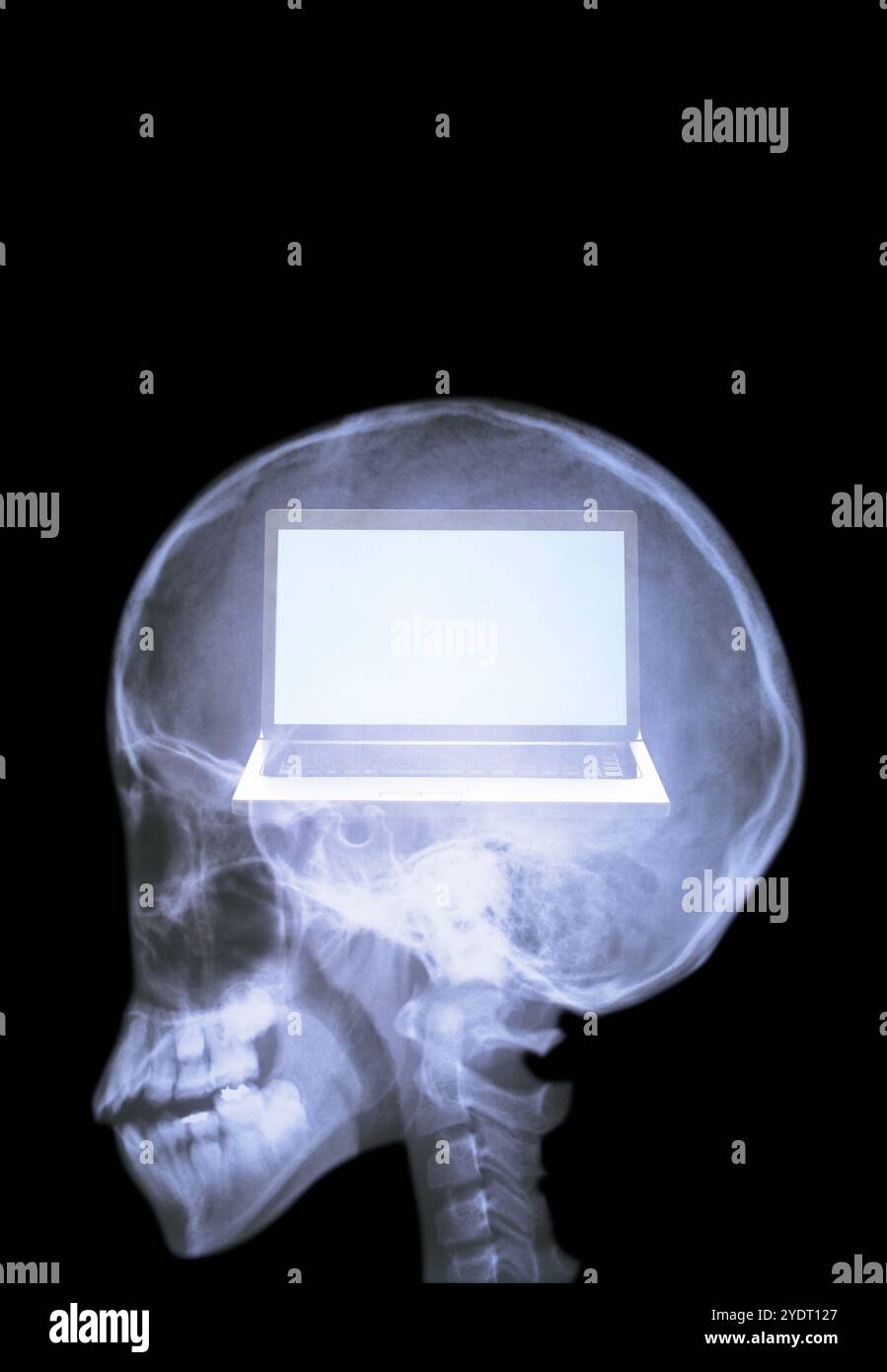 Radiograph of the brain Stock Photo