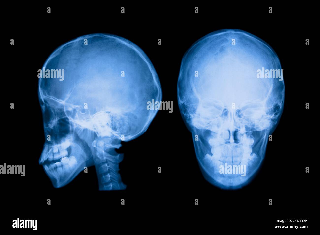 Radiograph of the brain Stock Photo