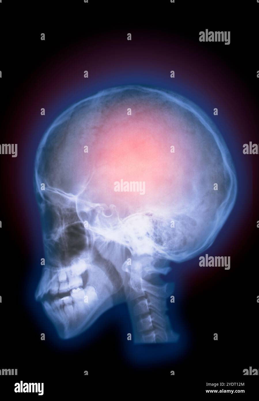 Radiograph of the brain Stock Photo