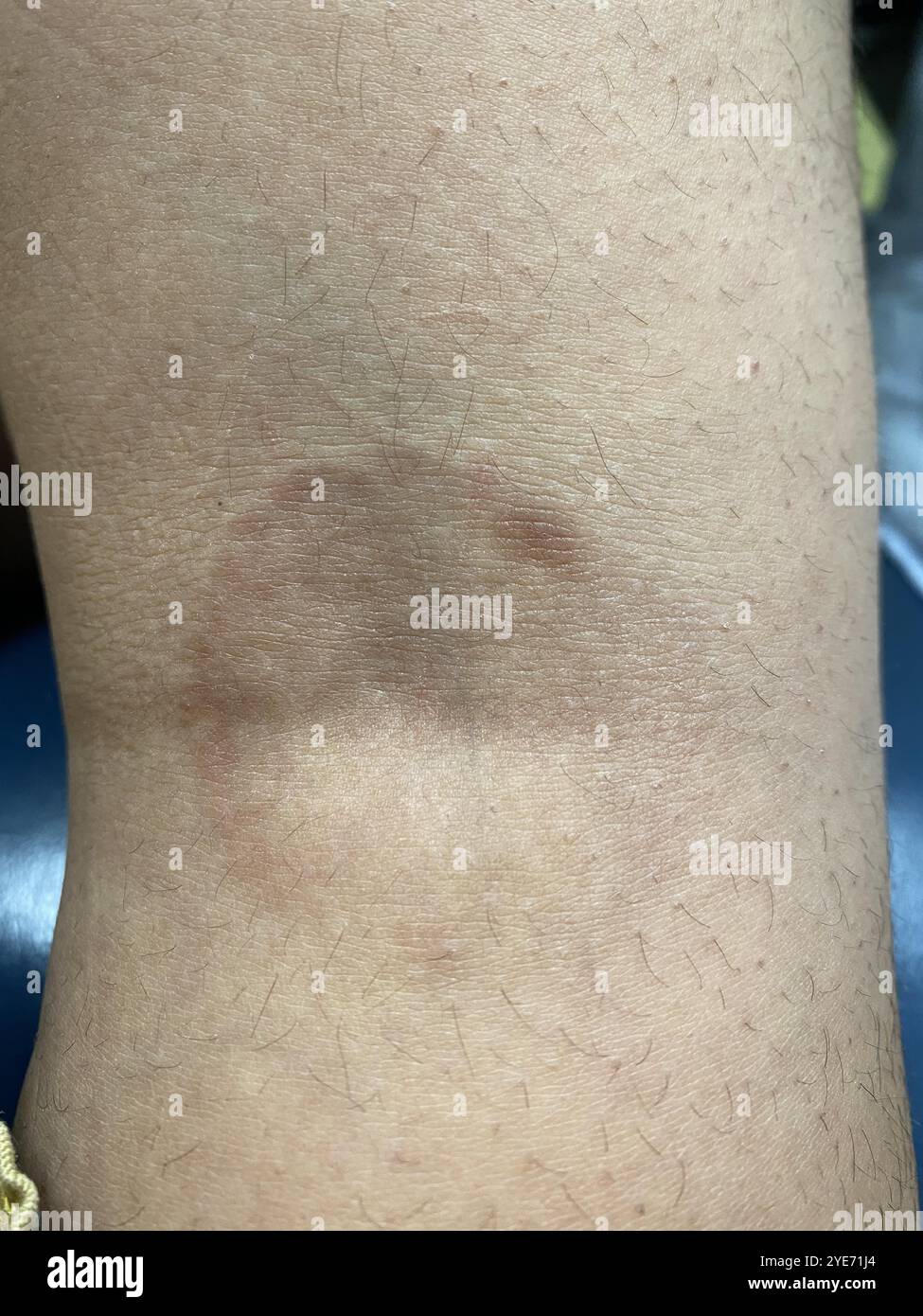 Granuloma annulare lesion on a patient's arm. This is a harmless, but ...