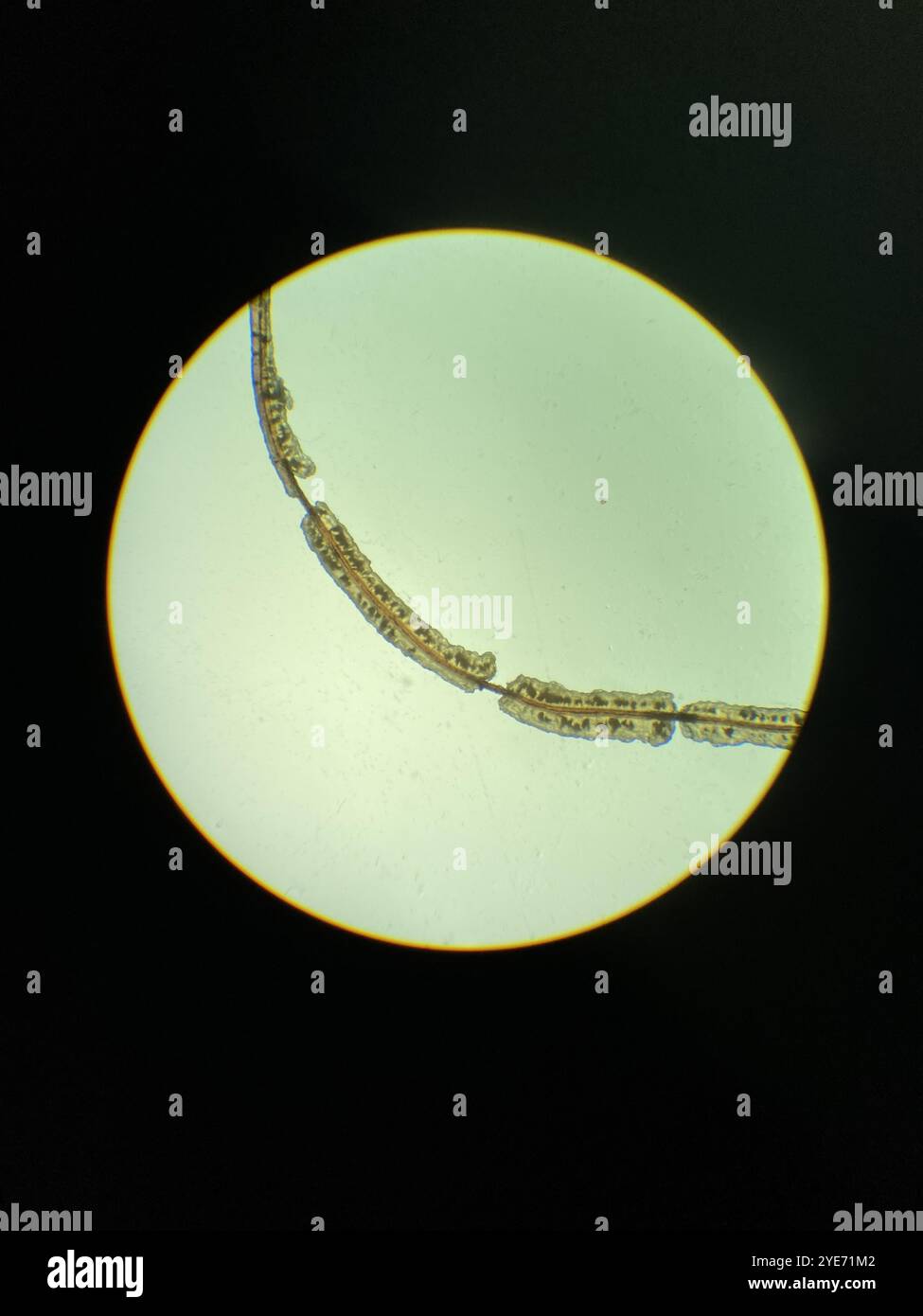 Light micrograph of trichomycosis in the armpit hair of a 65 year old white male patient. This is an infection of the hair with Corynebacterium sp. bacteria. The bacteria form a film (yellow) over the hair. It is usually asymptomatic. Treatment is with topical antiseptics or antibiotics. Stock Photo