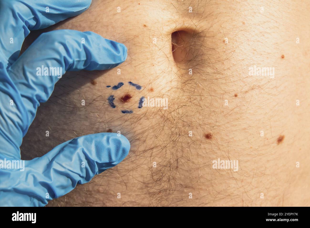 Doctor in medical gloves paint lines around male birthmarks. Preparing ...