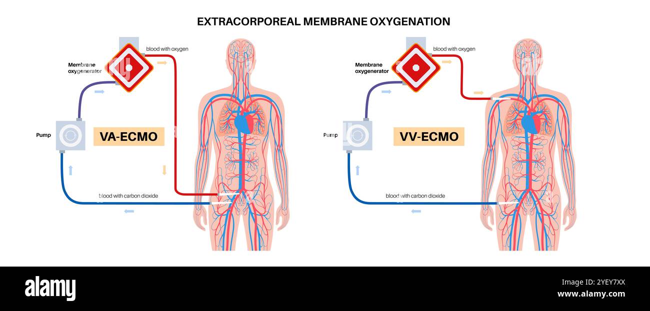 Conceptual illustration of extracorporeal membrane oxygenation. This ...