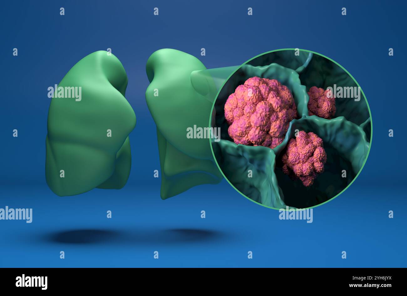 Lung cancer (LC) isometric view 3d illustration Stock Photo - Alamy