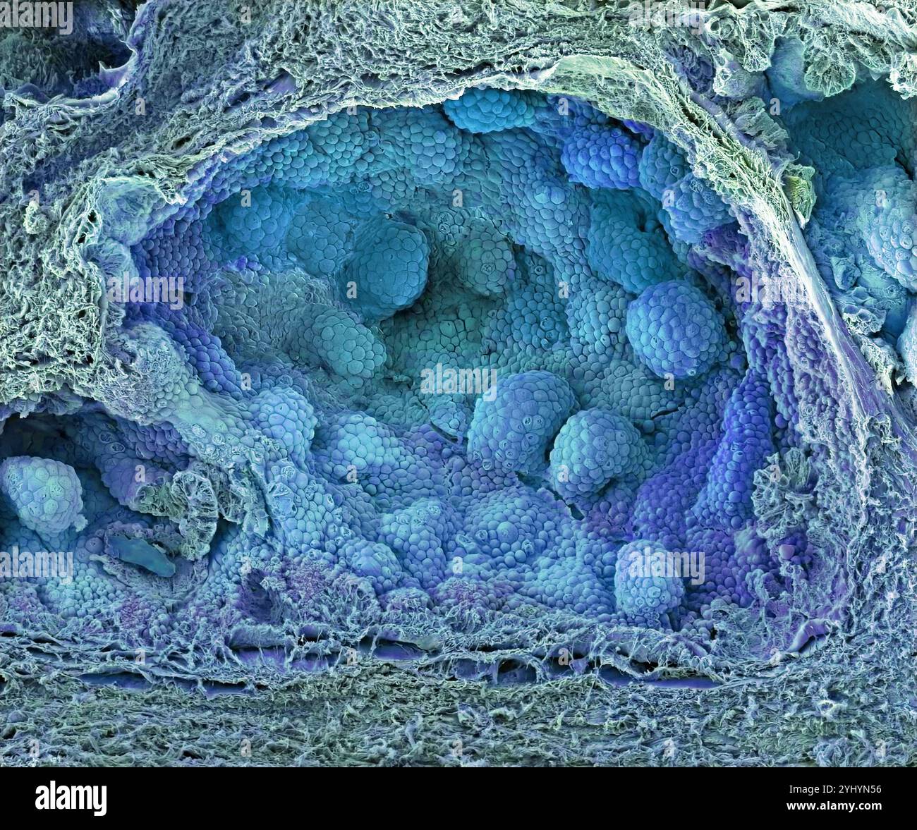 Prostate cancer. Coloured freeze-fracture scanning electron micrograph (SEM) of prostate cancer. The spherical glandular acini are lined with carcinoma cancer cells. Prostate cancer is one of the most common male cancers, usually affecting the elderly. The uncontrolled growth of the cancer obstructs the neck of the bladder, impairing urination. Treatment involves surgery to remove the prostate gland or radiotherapy. Magnification: x200 when printed 10 centimetres wide Stock Photo
