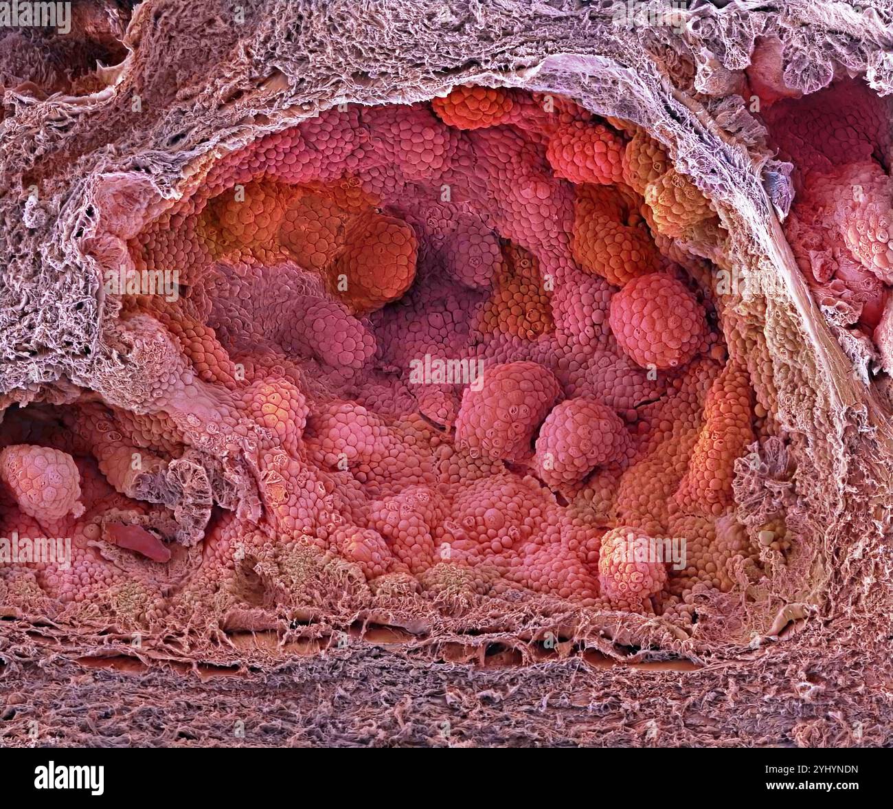 Prostate cancer. Coloured freeze-fracture scanning electron micrograph (SEM) of prostate cancer. The spherical glandular acini are lined with carcinoma cancer cells. Prostate cancer is one of the most common male cancers, usually affecting the elderly. The uncontrolled growth of the cancer obstructs the neck of the bladder, impairing urination. Treatment involves surgery to remove the prostate gland or radiotherapy. Magnification: x200 when printed 10 centimetres wide Stock Photo