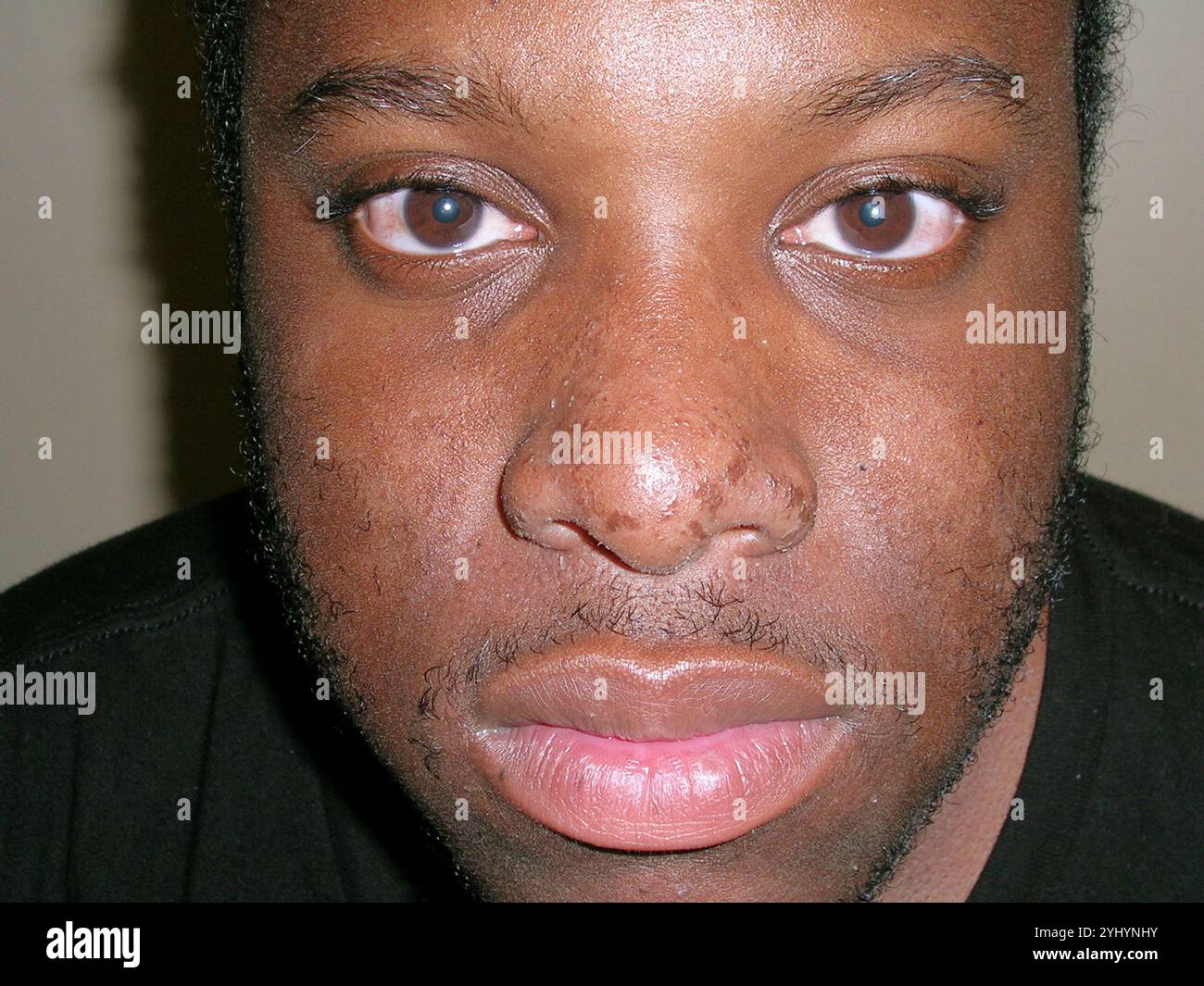 Oily skin, or seborrhoea, on the face of an African-American male patient. This condition is caused by the overproduction of sebum by the skin's sebaceous glands. Treatment is with regular gentle cleansing of the skin and topical retinoids. Stock Photo