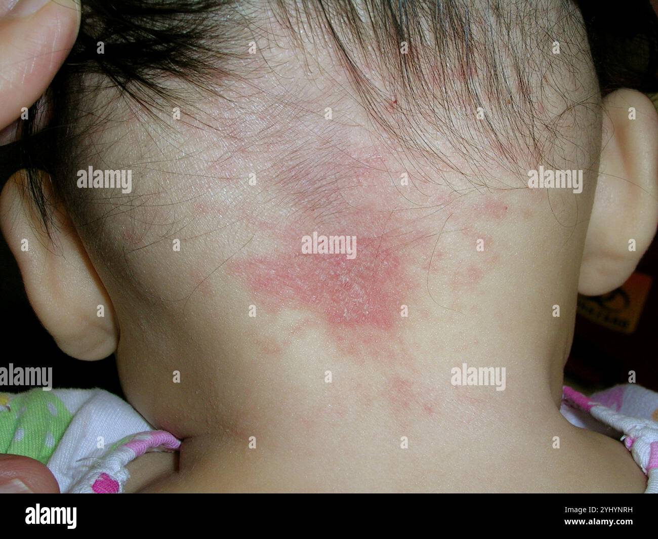 Stork bite birthmark and eczema on the back of the neck of a 5 month