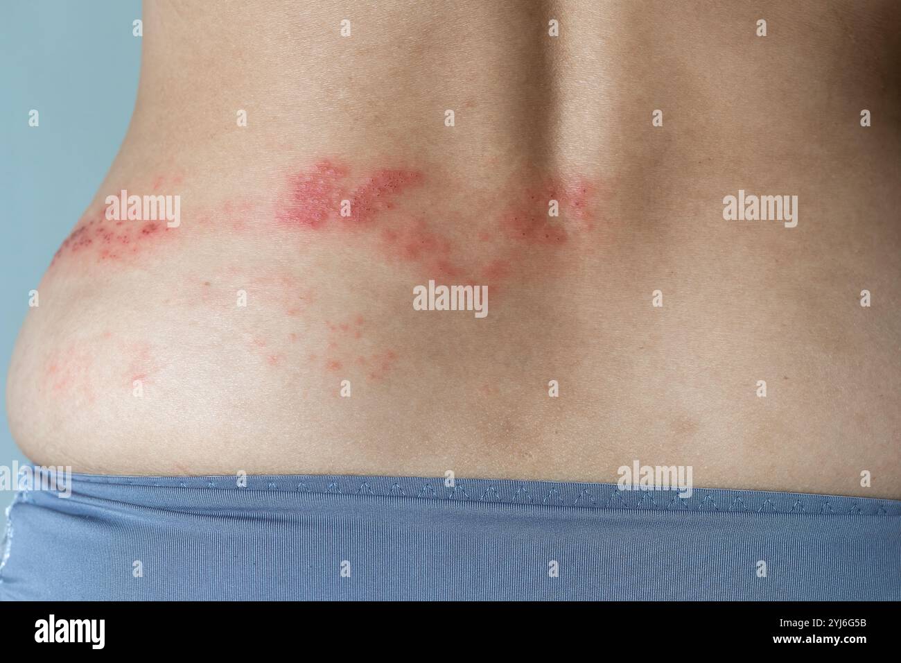 Herpes Zoster shingles disease on a woman back skin Stock Photo