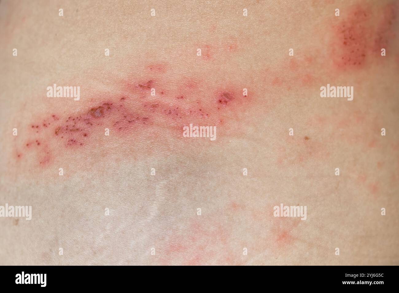 Herpes Zoster shingles disease on a woman back skin Stock Photo