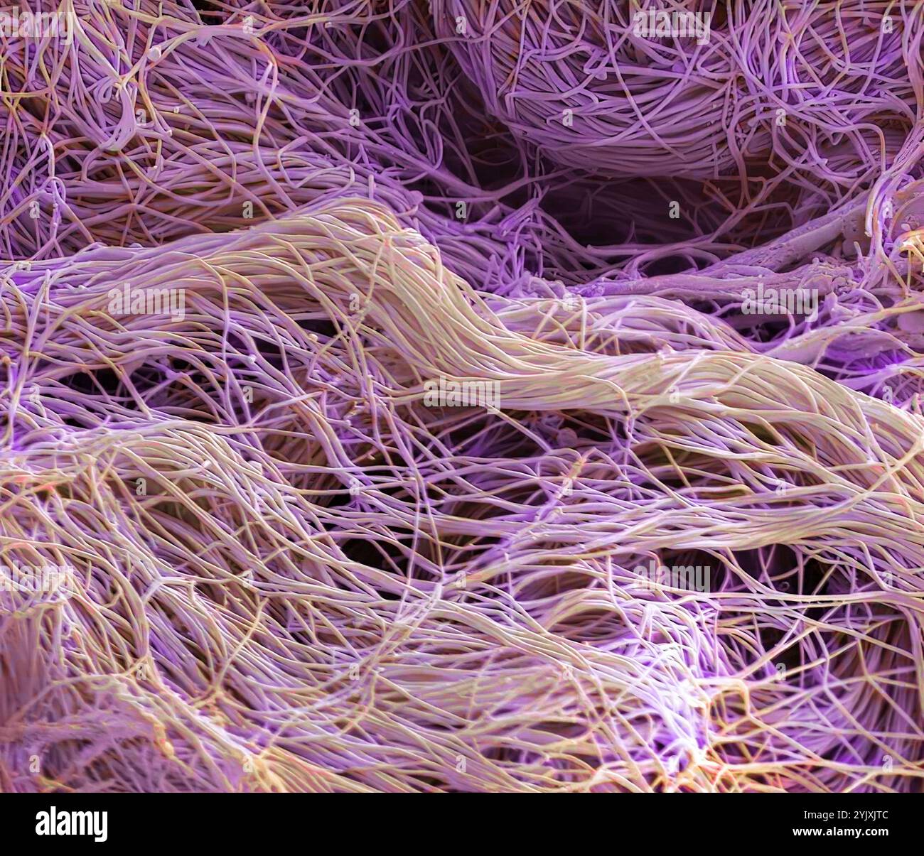 Connective tissue. Coloured scanning electron micrograph (SEM) of collagen from a nasal poly biopsy. Collagen is a protein with a high tensile strength, providing structure and elasticity to epithelium, tendons, ligaments and bones. It is the most abundant protein in the body. In the dermis, collagen forms rope-like fibres that are arranged irregularly. Magnification: x1300 when printed 10 centimetres wide. Stock Photo