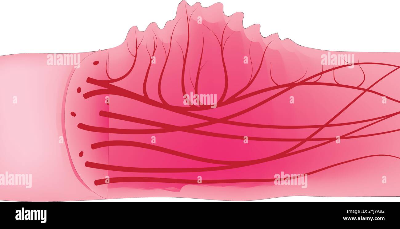 Cross Section Of Hemangiomas Cross Sectional View Of Hemangioma Stock