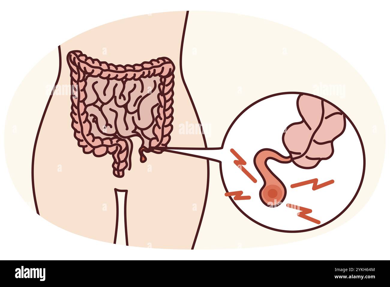 Closeup of human body with inflamed appendix. Person suffer from ...
