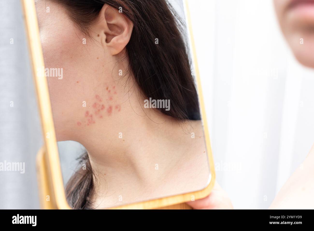 Why PCOS acne is different—and how to get it under control