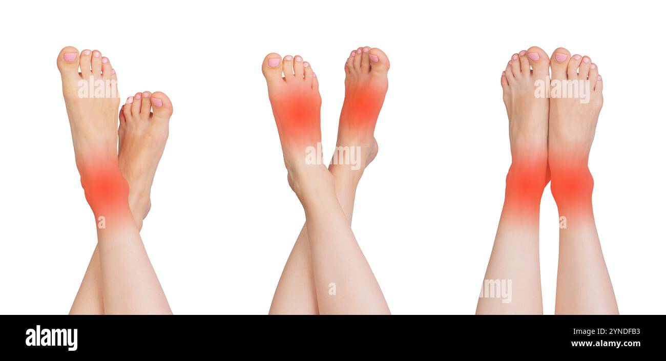 Set of female feet showing signs of pain, injury, and inflammation ...