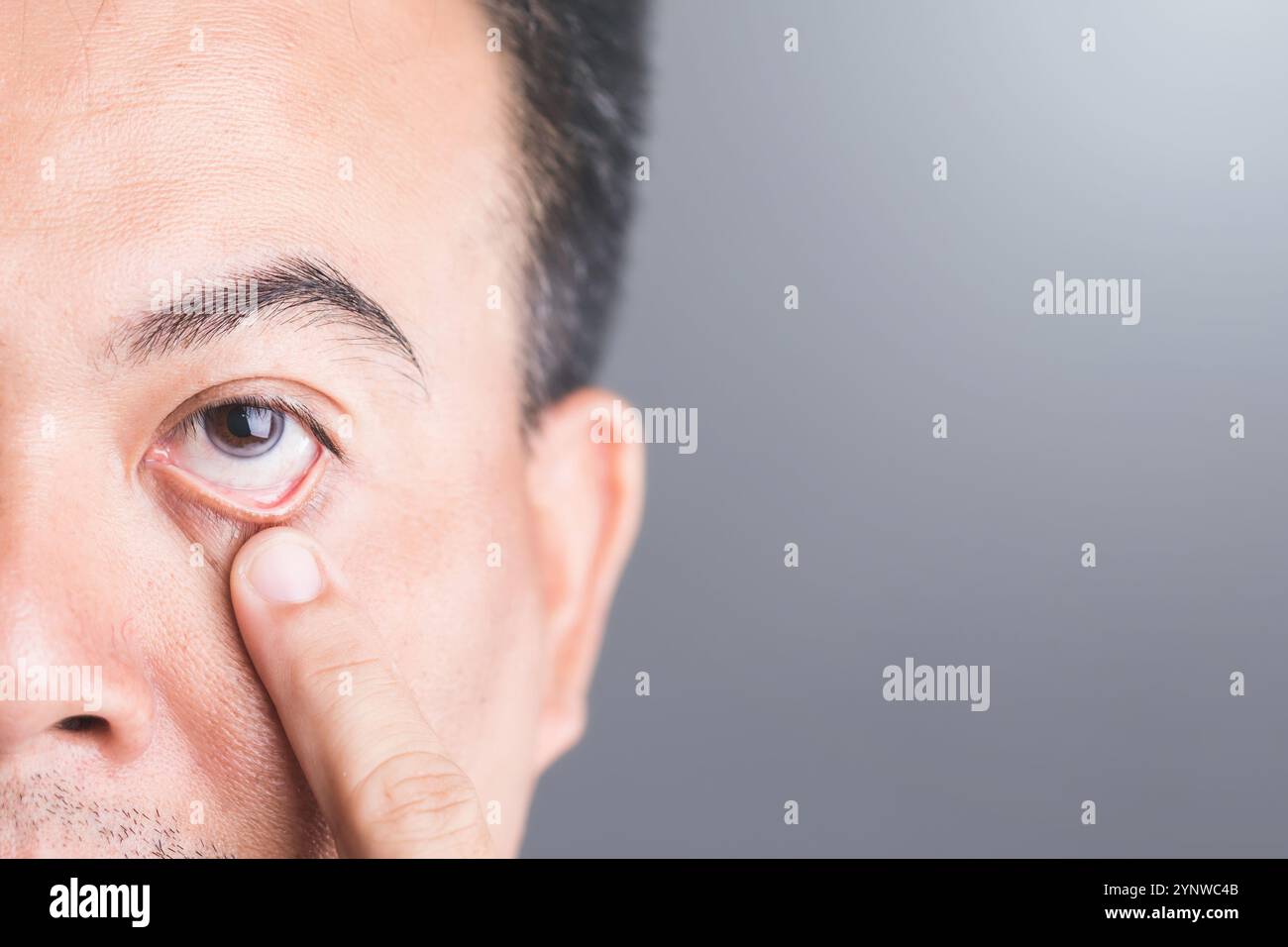 Close-up of a diabetic patient's eye, symbolizing the risks of diabetic retinopathy and macular degeneration. Emphasizes the importance of eye health Stock Photo