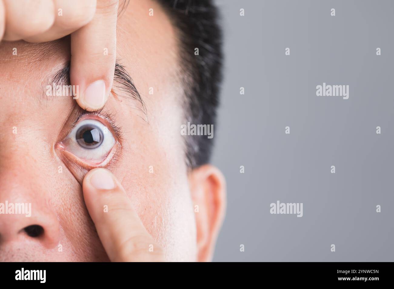 Close-up of a diabetic patient's eye, symbolizing the risks of diabetic retinopathy and macular degeneration. Emphasizes the importance of eye health Stock Photo