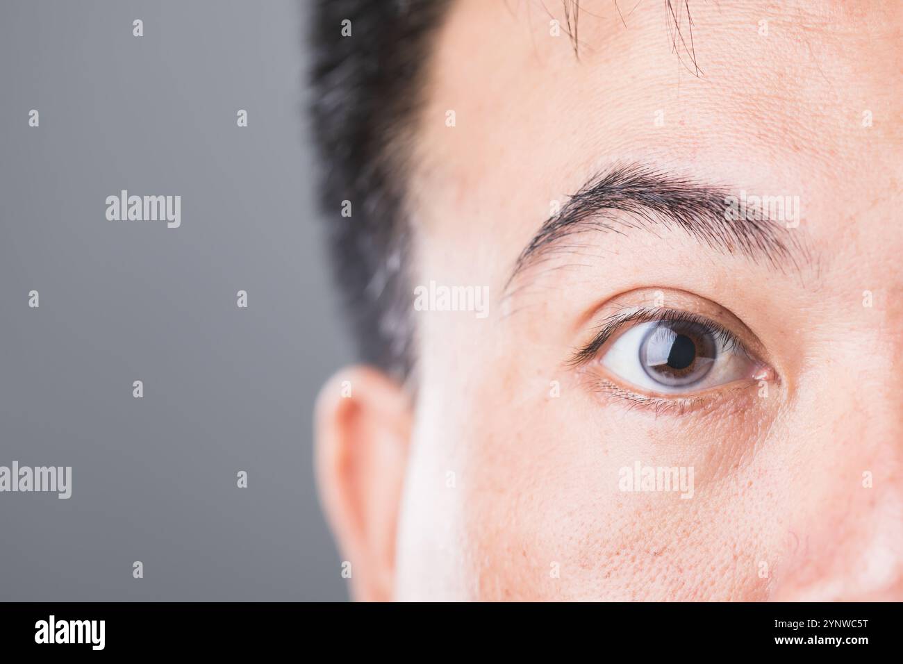 Close-up of a diabetic patient's eye, symbolizing the risks of diabetic retinopathy and macular degeneration. Emphasizes the importance of eye health Stock Photo