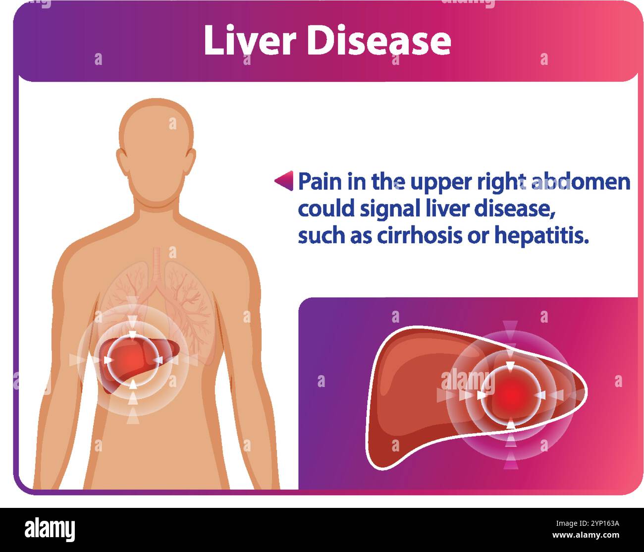 Illustration highlighting liver disease and symptoms Stock Vector Image ...