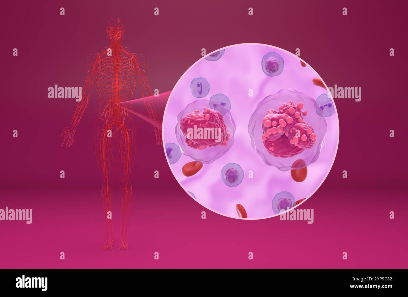 Chronic lymphocytic leukemia t cell hi-res stock photography and images ...