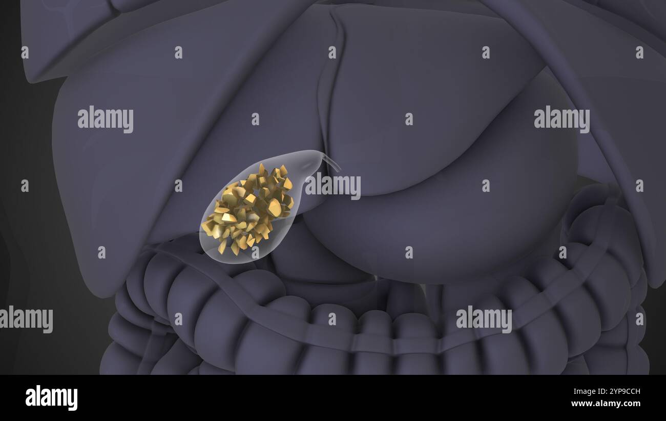 Gallstones Causing Obstruction in Bile Duct System Stock Photo - Alamy