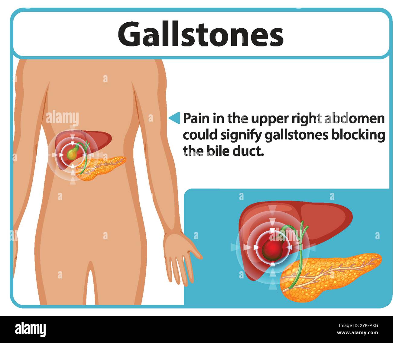 Illustration of gallstones affecting the bile duct Stock Vector Image ...