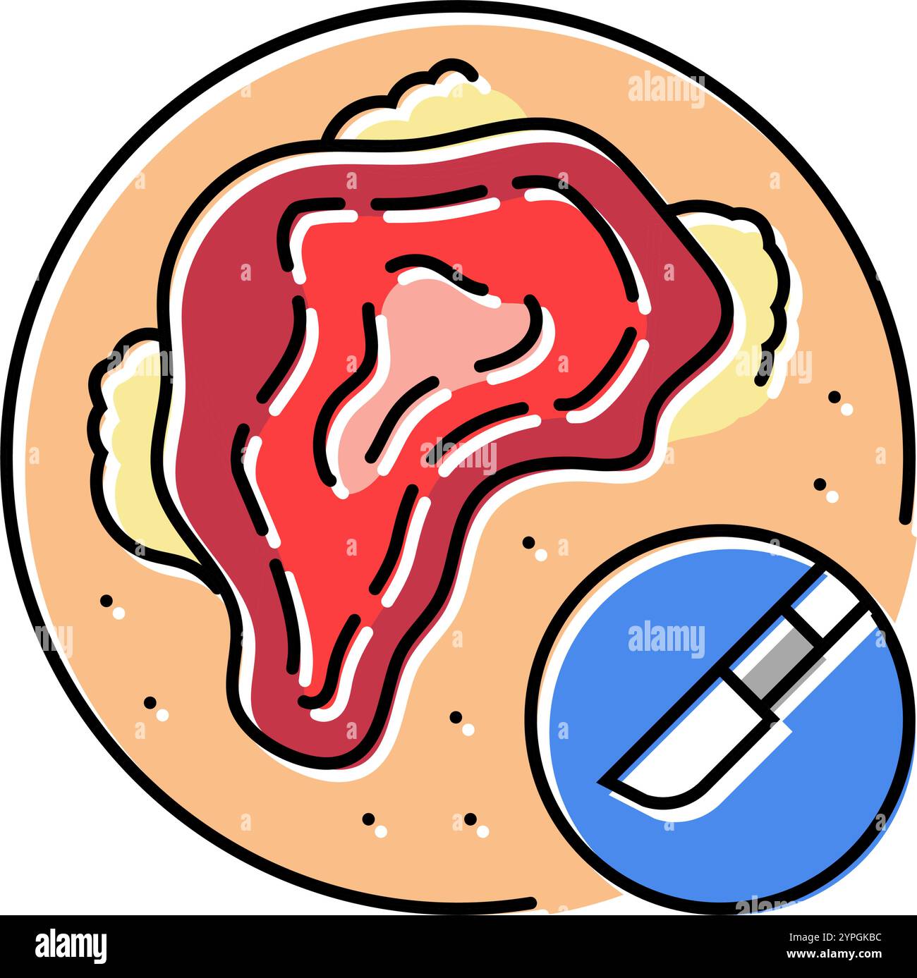 Debridement Stock Vector Images - Alamy