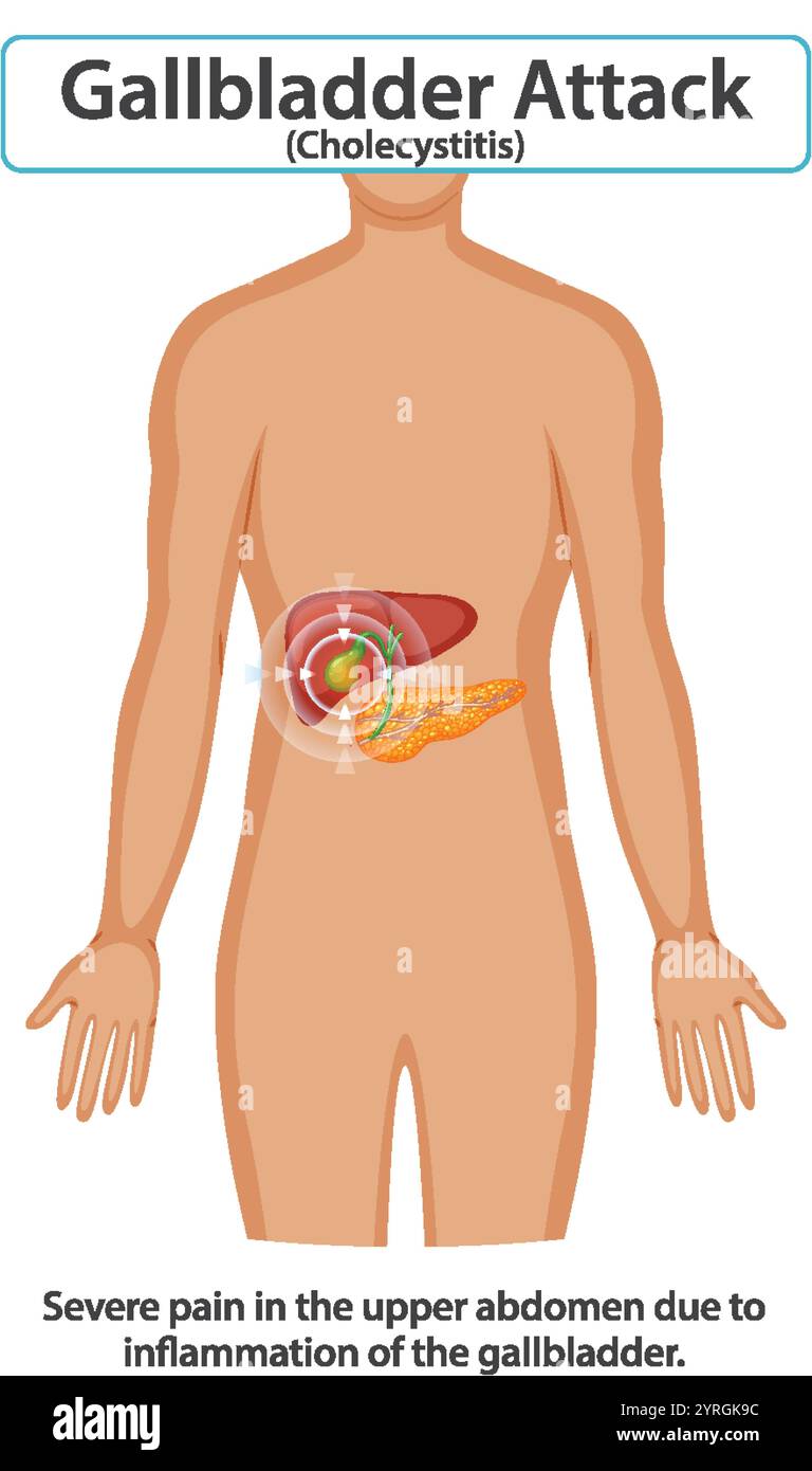 Illustration of gallbladder inflammation and abdominal pain Stock ...