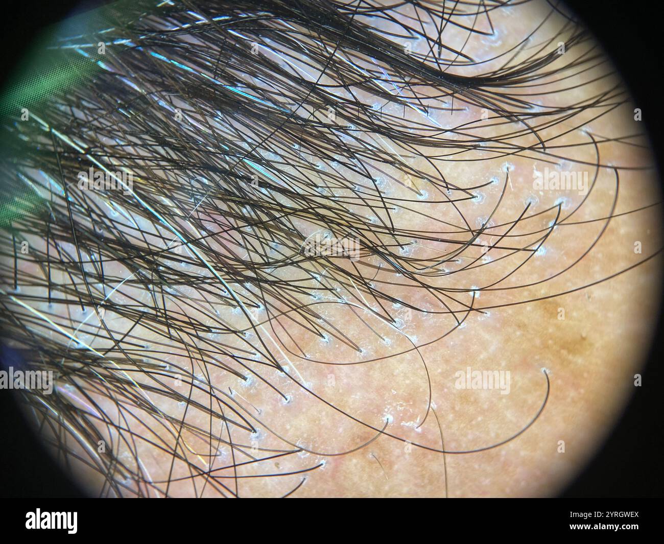 dermatoscope-image-of-frontal-fibrosing-alopecia-affecting-a-68-year