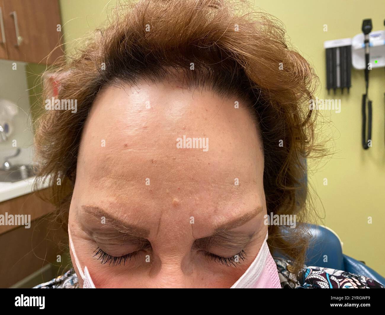 Frontal fibrosing alopecia affecting a female patient. This is a form of scarring hair loss along the hairline at the front of the scalp caused by inflammation and destruction of the hair follicles. The hair loss may be accompanied by red, flaky skin that can painful or itchy. Loss of hairs from the eyebrows is often also seen, and the hair loss may extend to other parts of the body. There is no cure, but hair loss may be slowed by steroids or anti-inflammatory antibiotics. Stock Photo