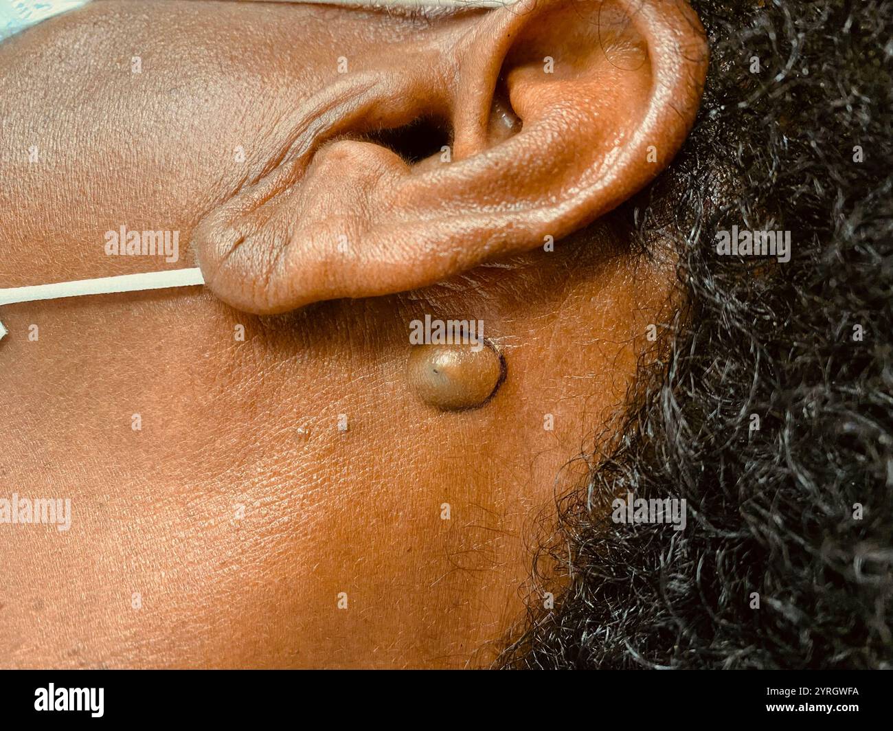 Epidermoid cyst behind the ear of a female African American patient ...