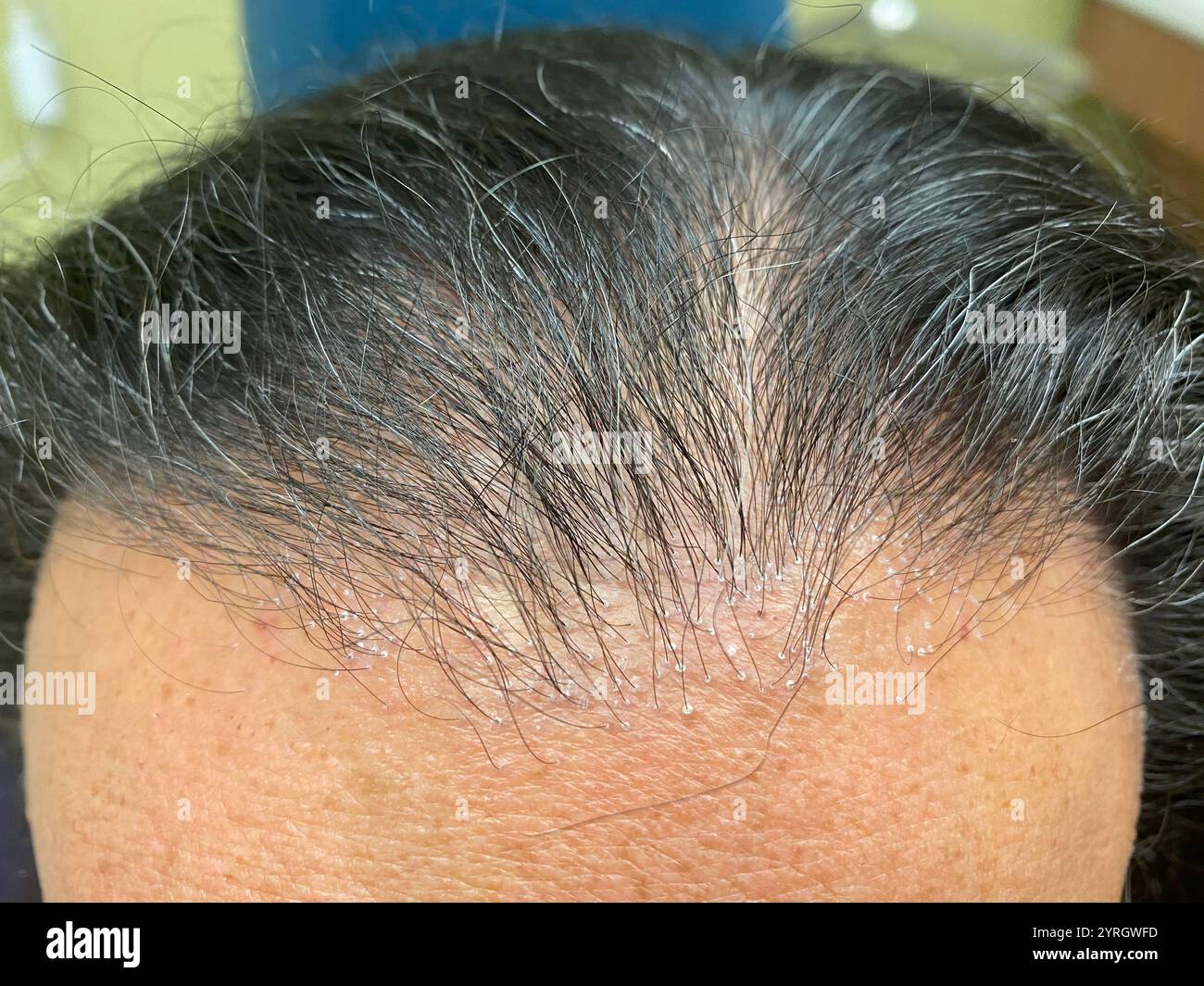 Frontal fibrosing alopecia affecting a 68 year old patient. This is a form of scarring hair loss along the hairline at the front of the scalp caused by inflammation and destruction of the hair follicles. The hair loss may be accompanied by red, flaky skin that can painful or itchy. Loss of hairs from the eyebrows is often also seen, and the hair loss may extend to other parts of the body. There is no cure, but hair loss may be slowed by steroids or anti-inflammatory antibiotics. Stock Photo