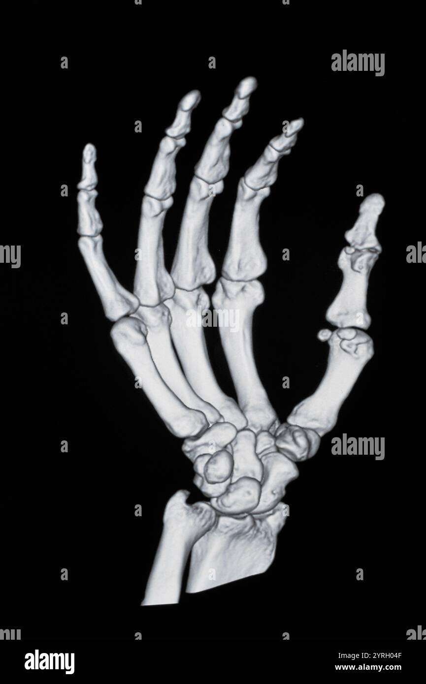 Hand Annotation X Ray X-ray of hand Stock Photo - Alamy