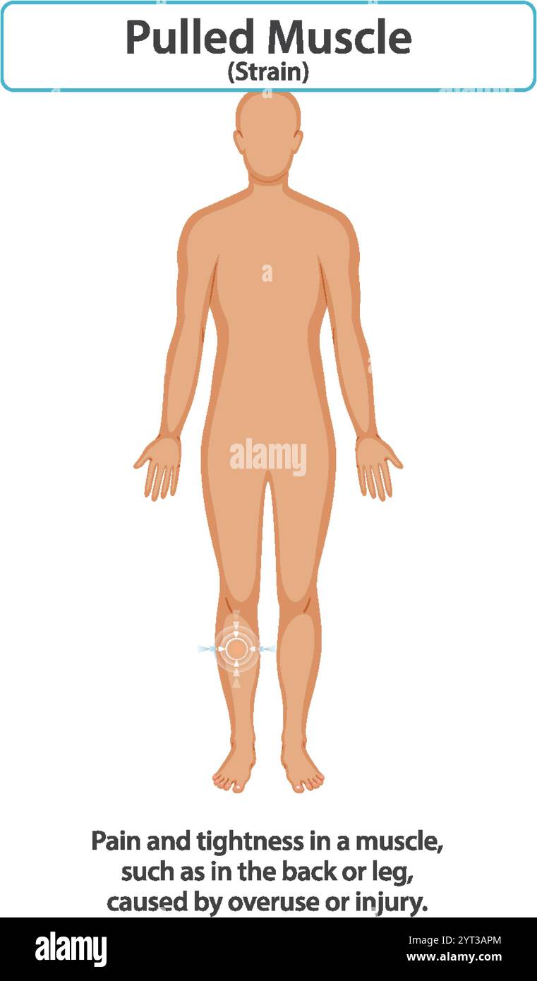 Illustration of muscle strain in human body Stock Vector Image & Art ...