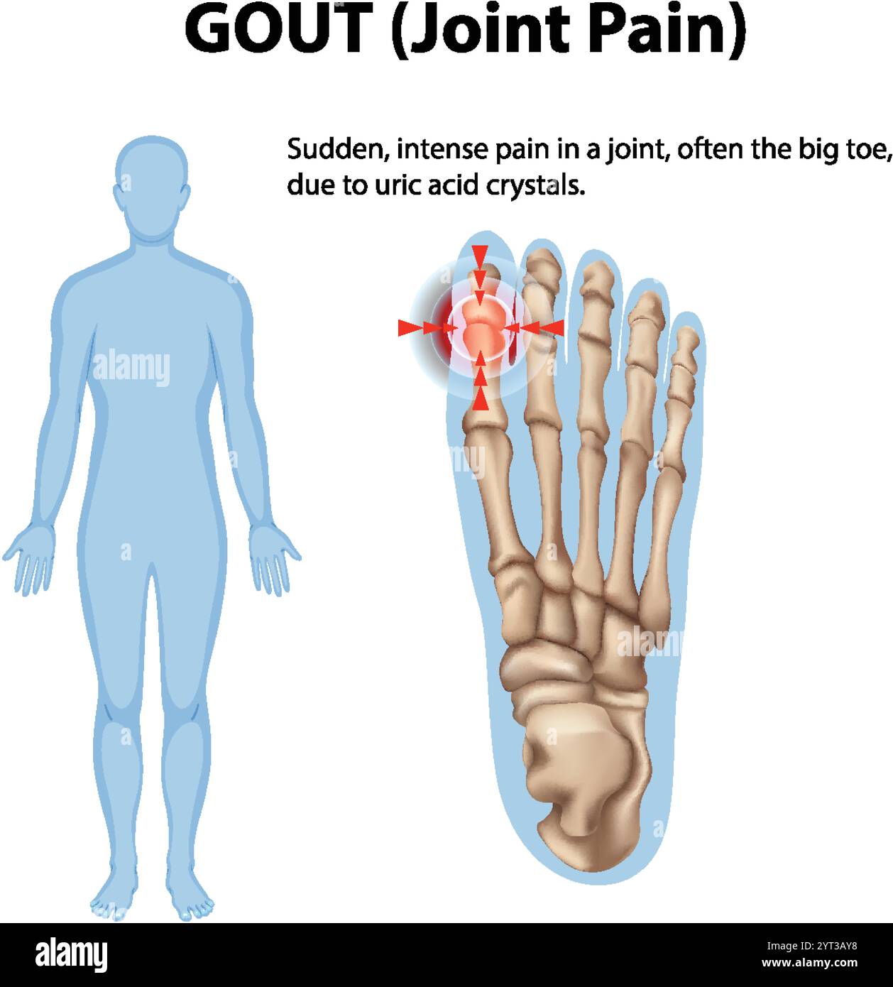 Illustration of gout affecting the human foot joint Stock Vector Image ...