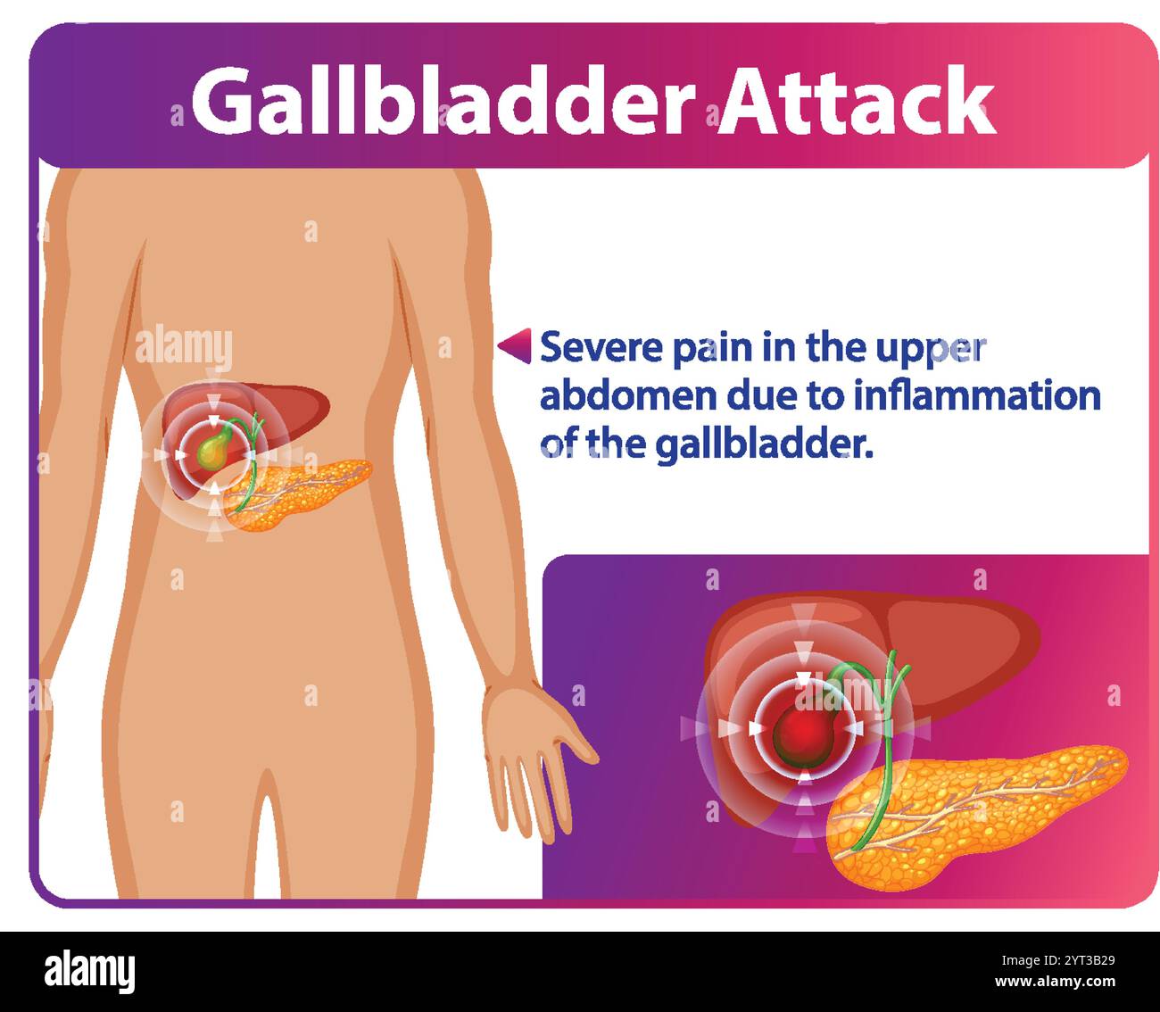 Illustration of gallbladder pain and inflammation Stock Vector Image